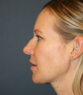 Feel Beautiful - Nose Surgery 228 - Before Photo